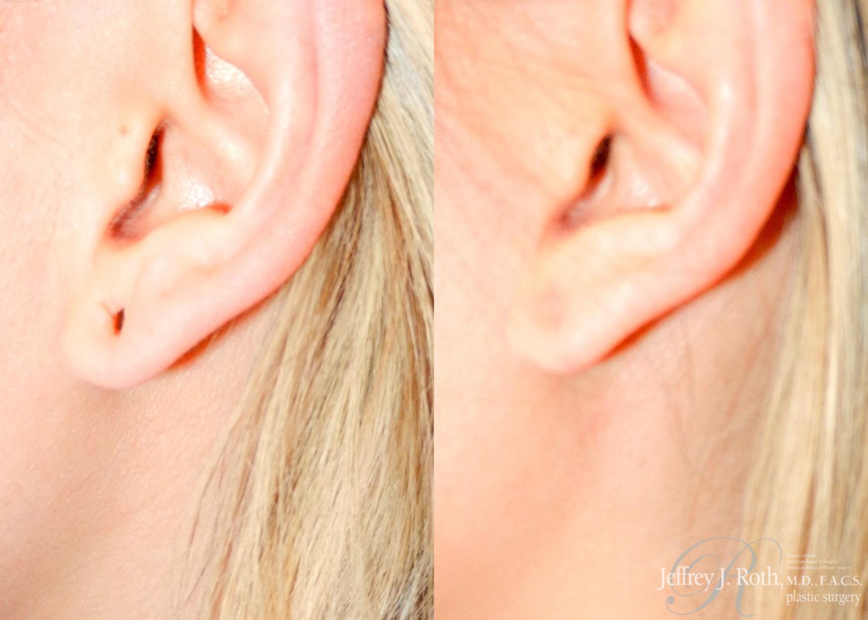 Before & After Earlobe Repair Surgery Case 121 View #3 View in Las Vegas, NV