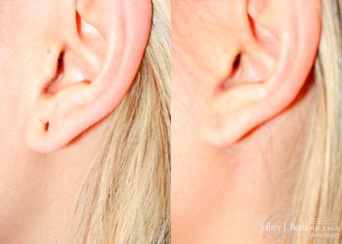 Before & After Earlobe Repair Surgery Case 121 View #3 View in Las Vegas and Henderson, NV