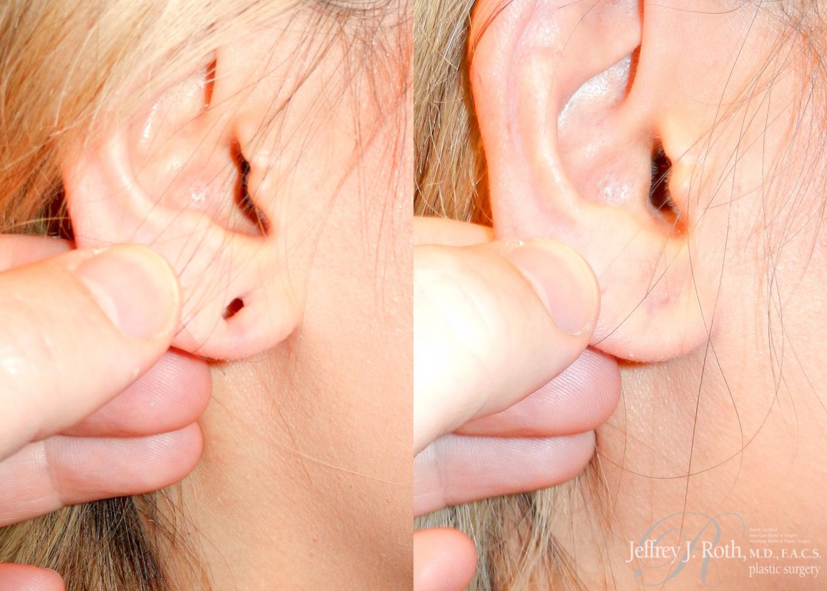 Before & After Earlobe Repair Surgery Case 121 View #5 View in Las Vegas, NV