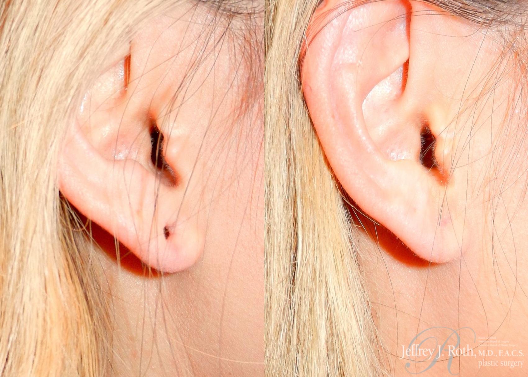 Before & After Earlobe Repair Surgery Case 121 View #6 View in Las Vegas, NV