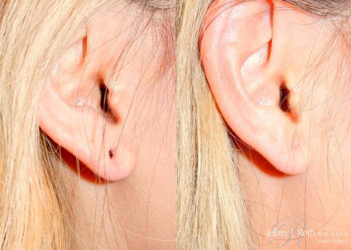 Before & After Earlobe Repair Surgery Case 121 View #6 View in Las Vegas and Henderson, NV