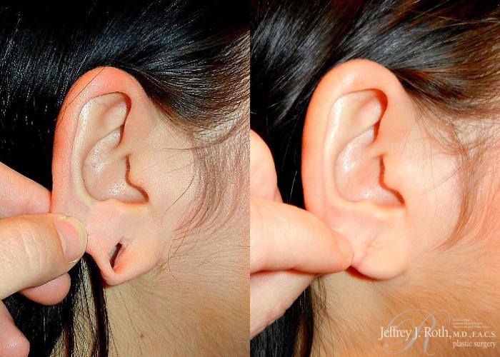 Before & After Earlobe Repair Surgery Case 122 View #2 View in Las Vegas, NV