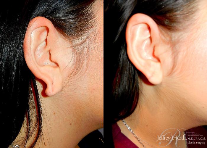 Before & After Earlobe Repair Surgery Case 123 View #1 View in Las Vegas, NV
