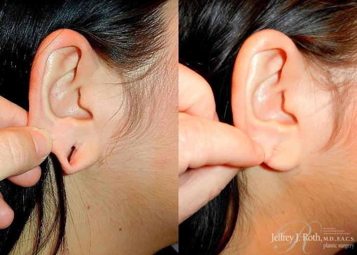 Before & After Earlobe Repair Surgery Case 123 View #2 View in Las Vegas, NV