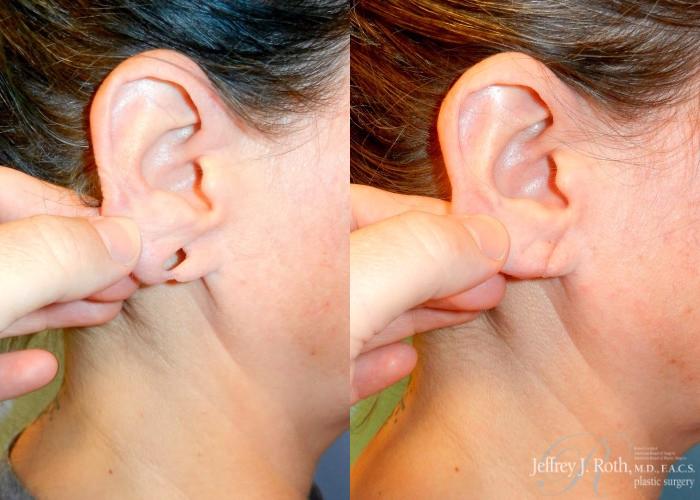 Before & After Earlobe Repair Surgery Case 124 View #1 View in Las Vegas, NV
