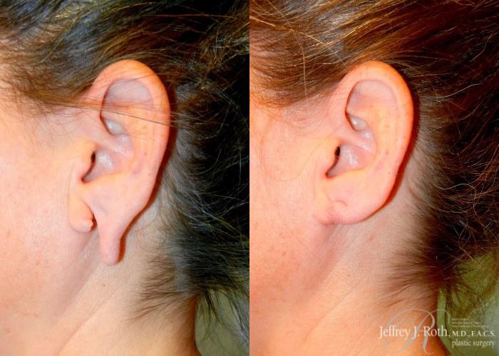 Before & After Earlobe Repair Surgery Case 124 View #2 View in Las Vegas and Henderson, NV