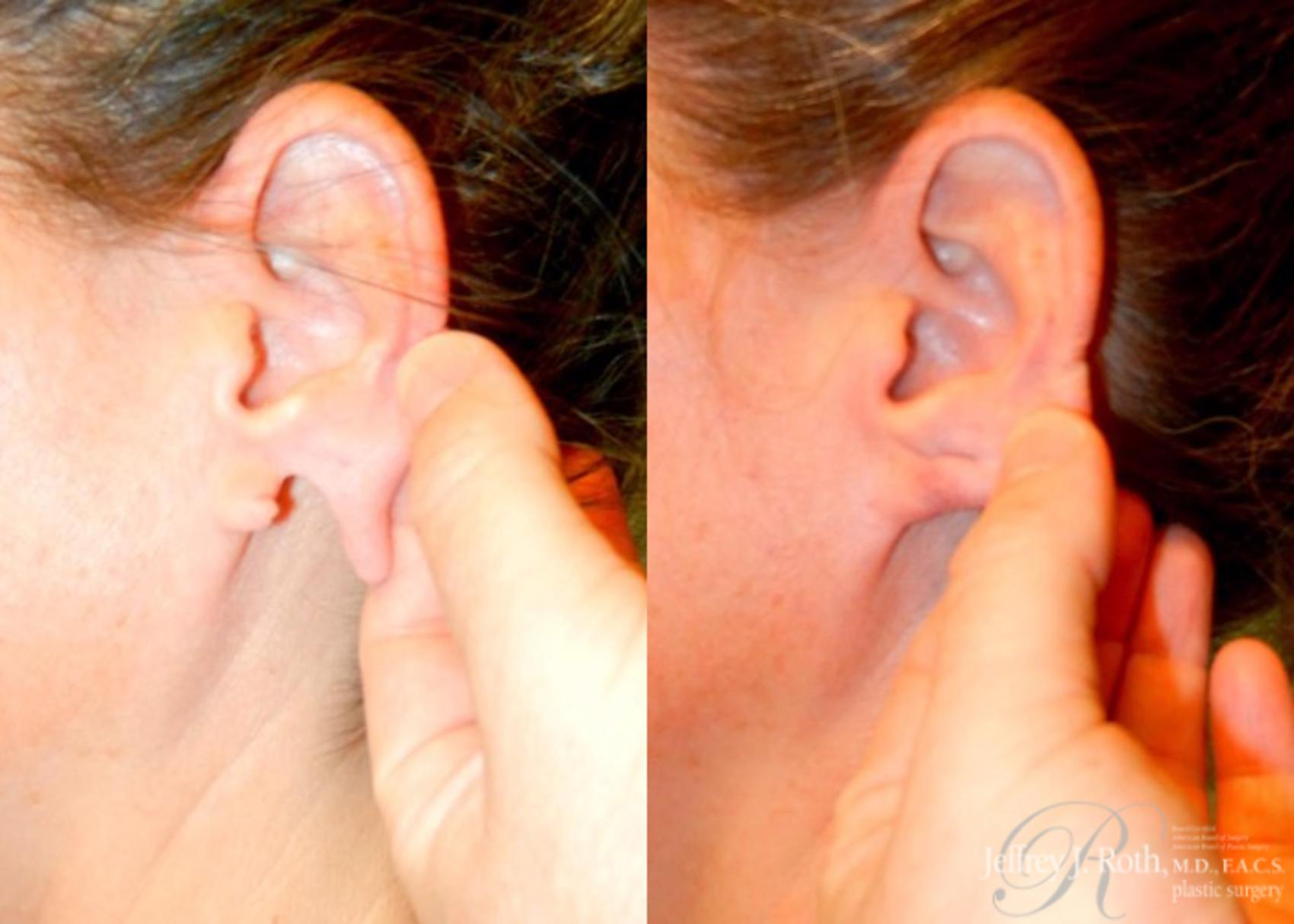 Before & After Earlobe Repair Surgery Case 124 View #3 View in Las Vegas, NV