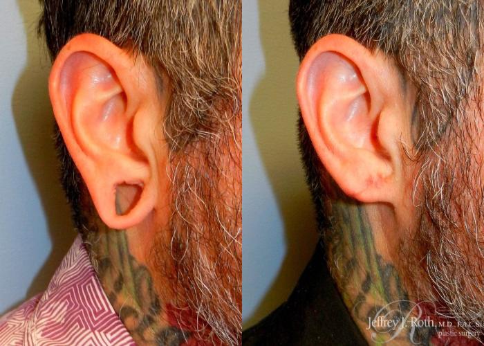 Before & After Earlobe Repair Surgery Case 125 View #2 View in Las Vegas and Henderson, NV