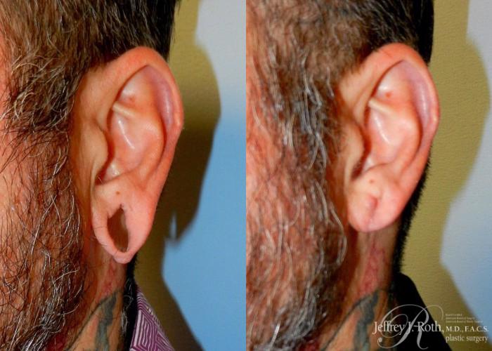 Before & After Earlobe Repair Surgery Case 125 View #3 View in Las Vegas and Henderson, NV