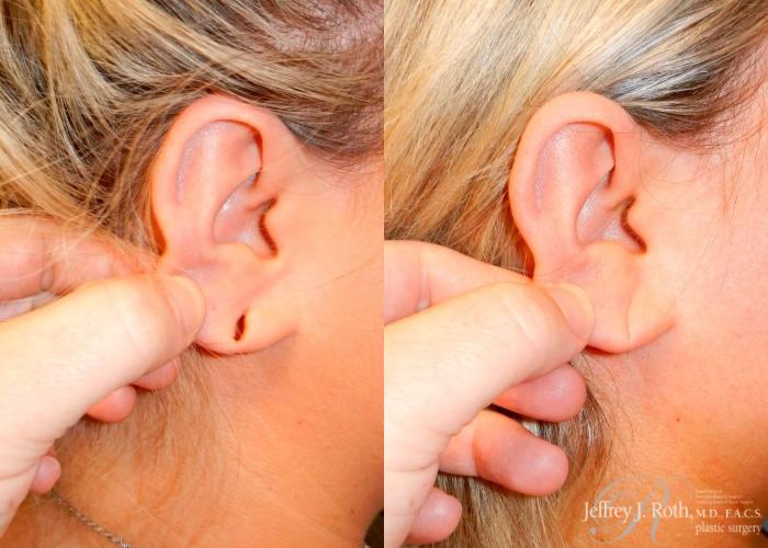 Before & After Earlobe Repair Surgery Case 126 View #1 View in Las Vegas, NV