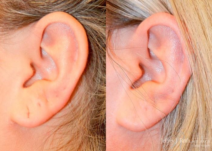 Before & After Earlobe Repair Surgery Case 126 View #3 View in Las Vegas, NV