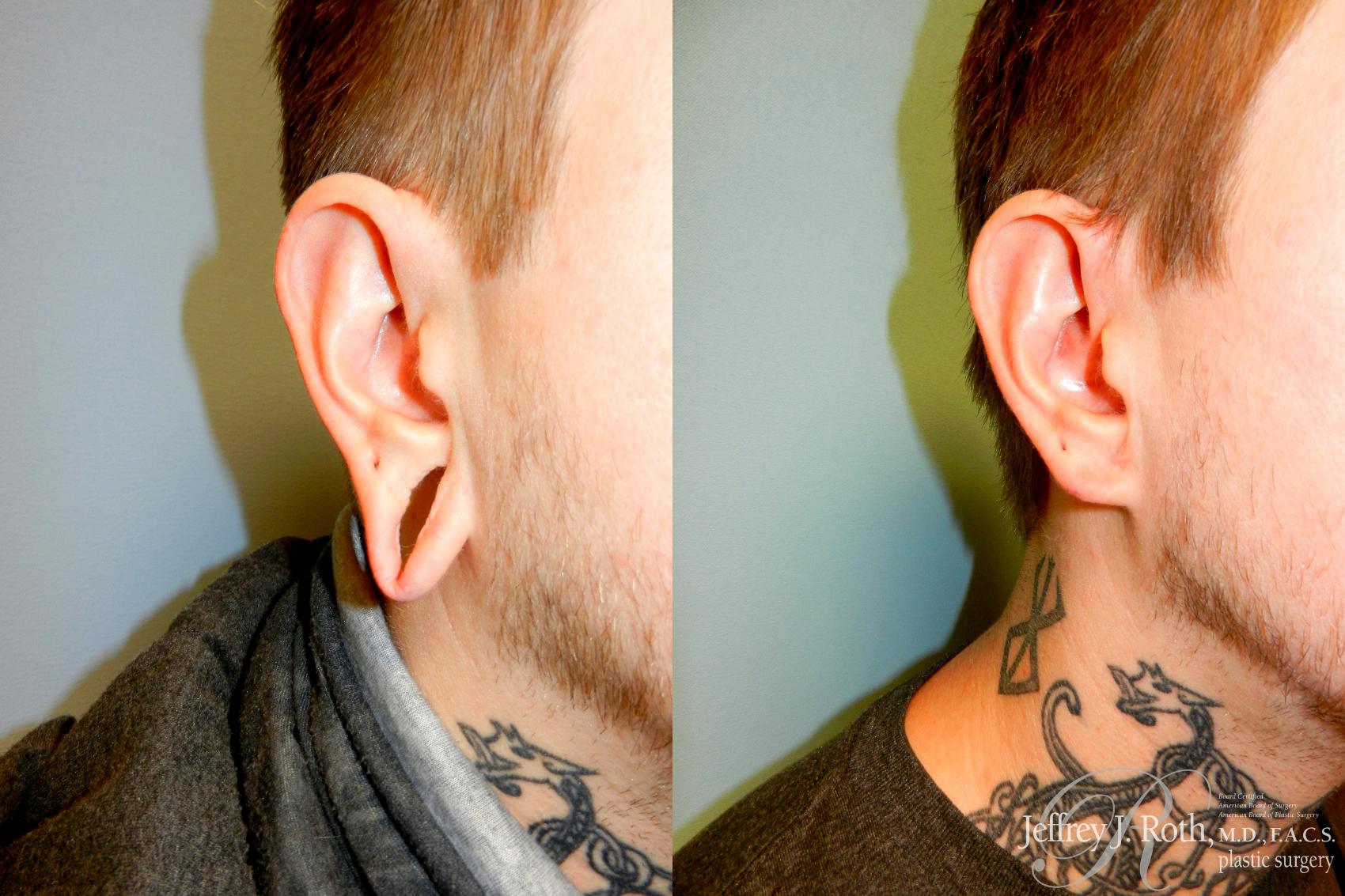 Before & After Earlobe Repair Surgery Case 228 Left Oblique View in Las Vegas, NV