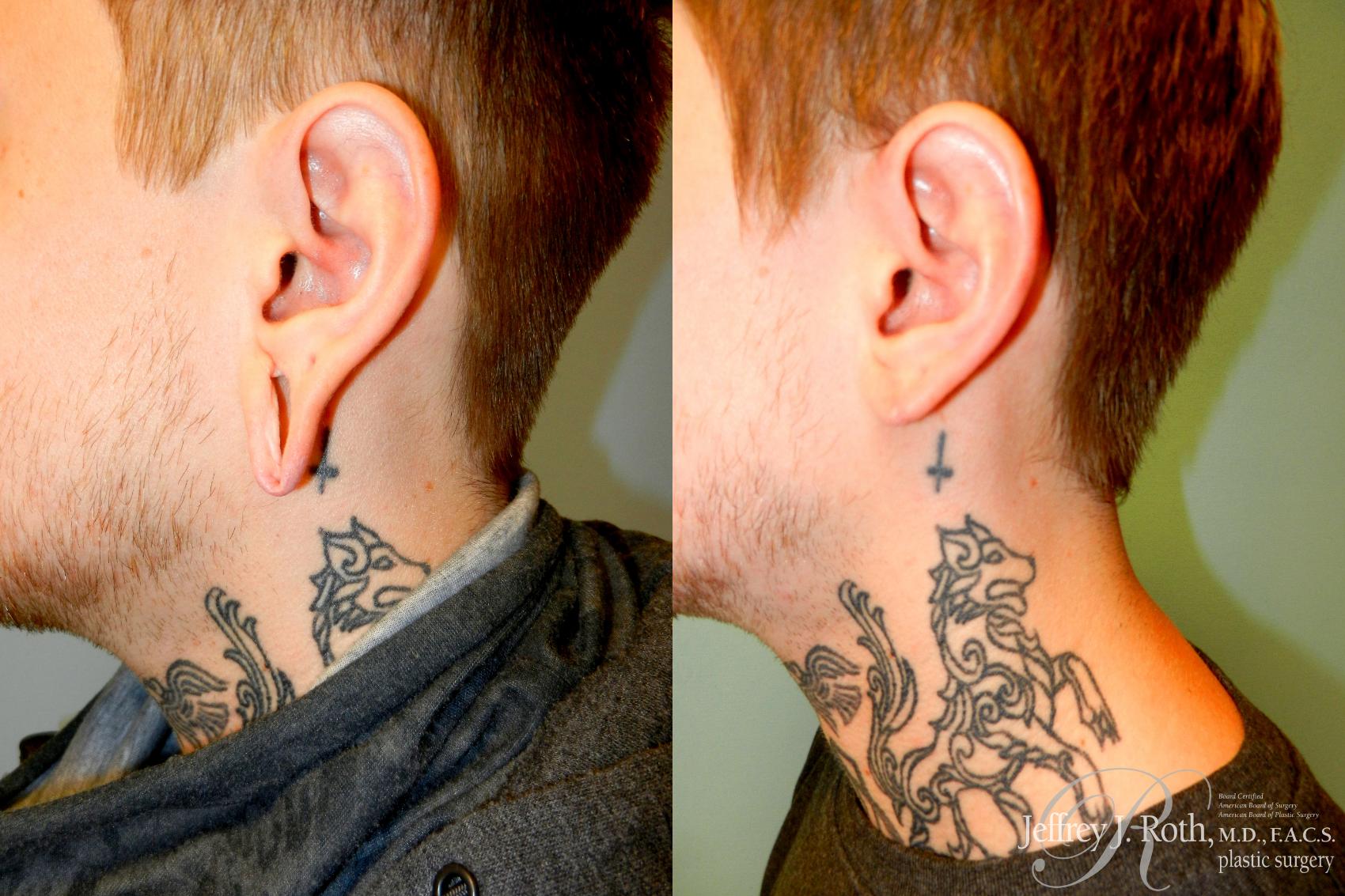 Before & After Earlobe Repair Surgery Case 228 Left Side View in Las Vegas, NV