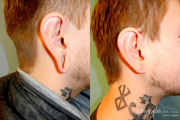 Before & After Earlobe Repair Surgery Case 228 Right Side View in Las Vegas, NV