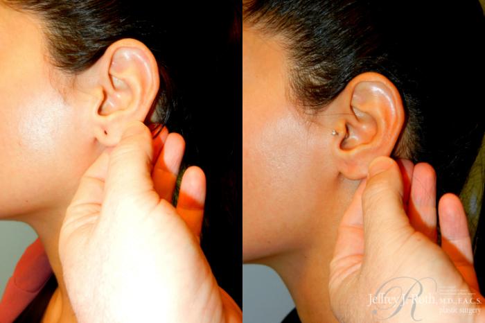 Before & After Earlobe Repair Surgery Case 233 L Side w/ Tension View in Las Vegas and Henderson, NV