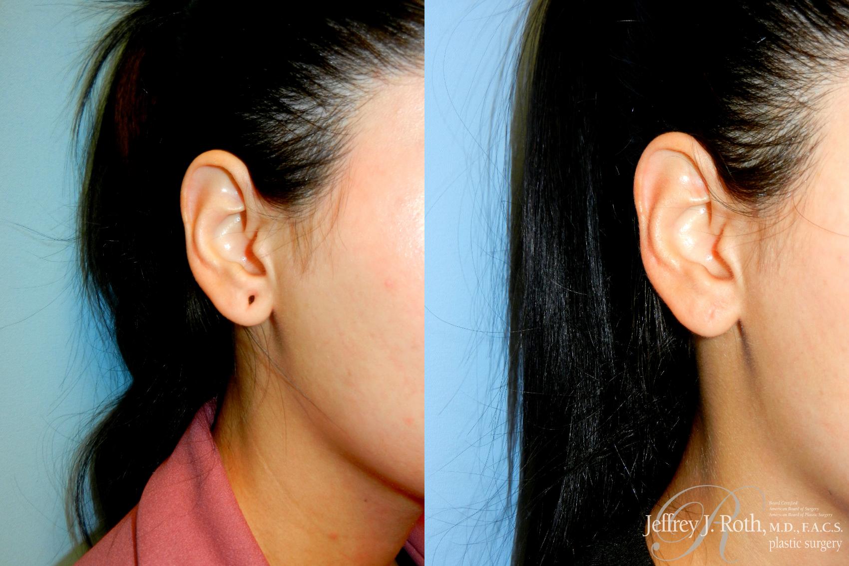 Before & After Earlobe Repair Surgery Case 233 Right Oblique View in Las Vegas and Henderson, NV