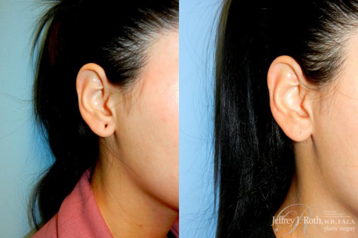 Before & After Earlobe Repair Surgery Case 233 Right Oblique View in Las Vegas, NV