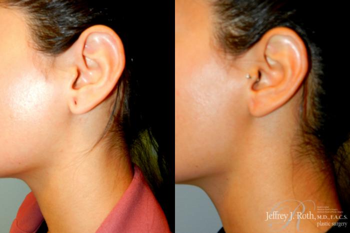 Before & After Earlobe Repair Surgery Case 233 Right Side View in Las Vegas and Henderson, NV