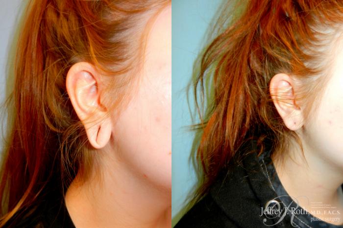 Before & After Earlobe Repair Surgery Case 236 Left Oblique View in Las Vegas and Henderson, NV