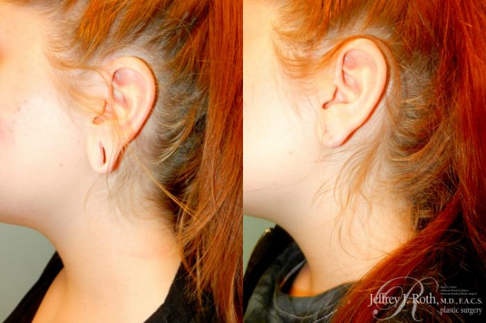 Before & After Earlobe Repair Surgery Case 236 Left Side View in Las Vegas and Henderson, NV
