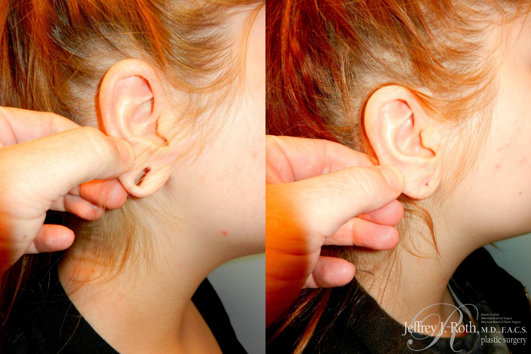 Before & After Earlobe Repair Surgery Case 236 Right Side View in Las Vegas and Henderson, NV
