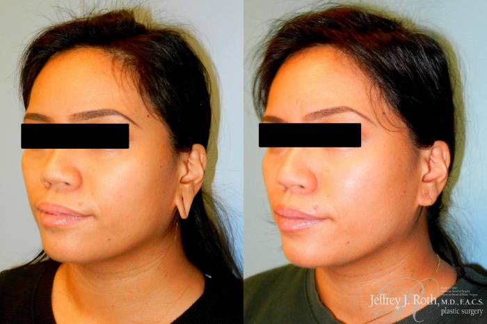 Before & After Earlobe Repair Surgery Case 240 Left Oblique View in Las Vegas, NV