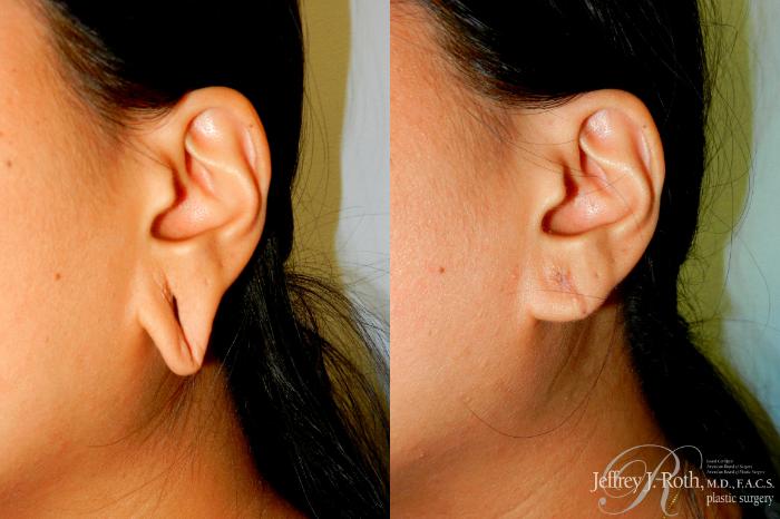 Before & After Earlobe Repair Surgery Case 240 Left Side View in Las Vegas, NV