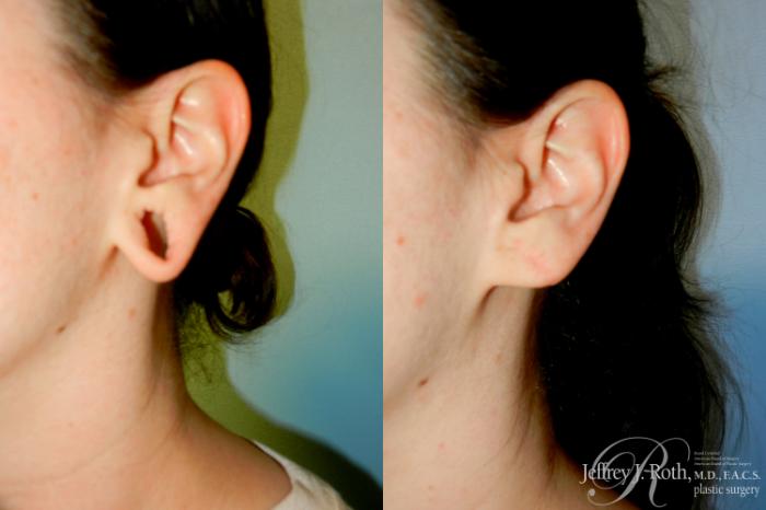 Before & After Earlobe Repair Surgery Case 249 Left Oblique View in Las Vegas, NV