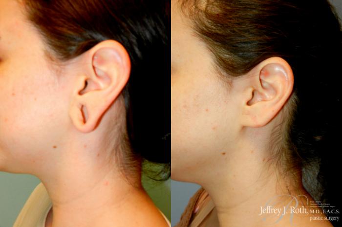 Before & After Earlobe Repair Surgery Case 249 Left Side 2 View in Las Vegas and Henderson, NV