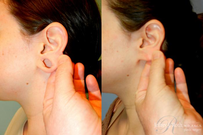 Before & After Earlobe Repair Surgery Case 249 Left Side View in Las Vegas and Henderson, NV