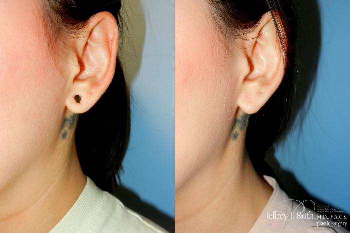 Before & After Earlobe Repair Surgery Case 255 Left Oblique View in Las Vegas and Henderson, NV
