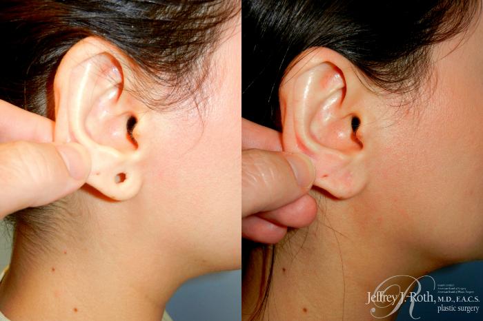 Before & After Earlobe Repair Surgery Case 255 Right Side 2 View in Las Vegas and Henderson, NV