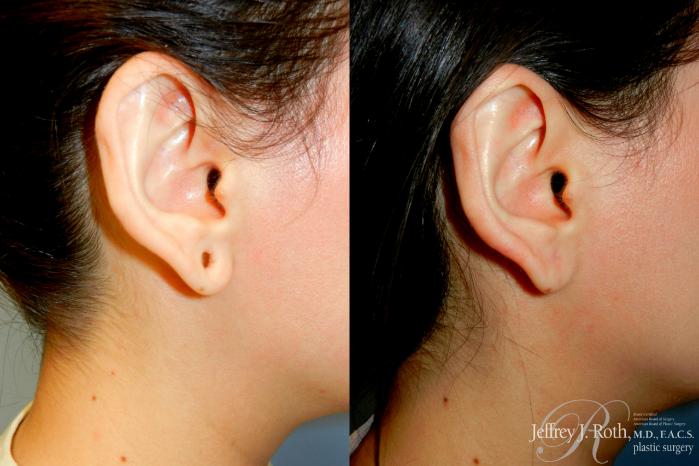 Before & After Earlobe Repair Surgery Case 255 Right Side View in Las Vegas and Henderson, NV