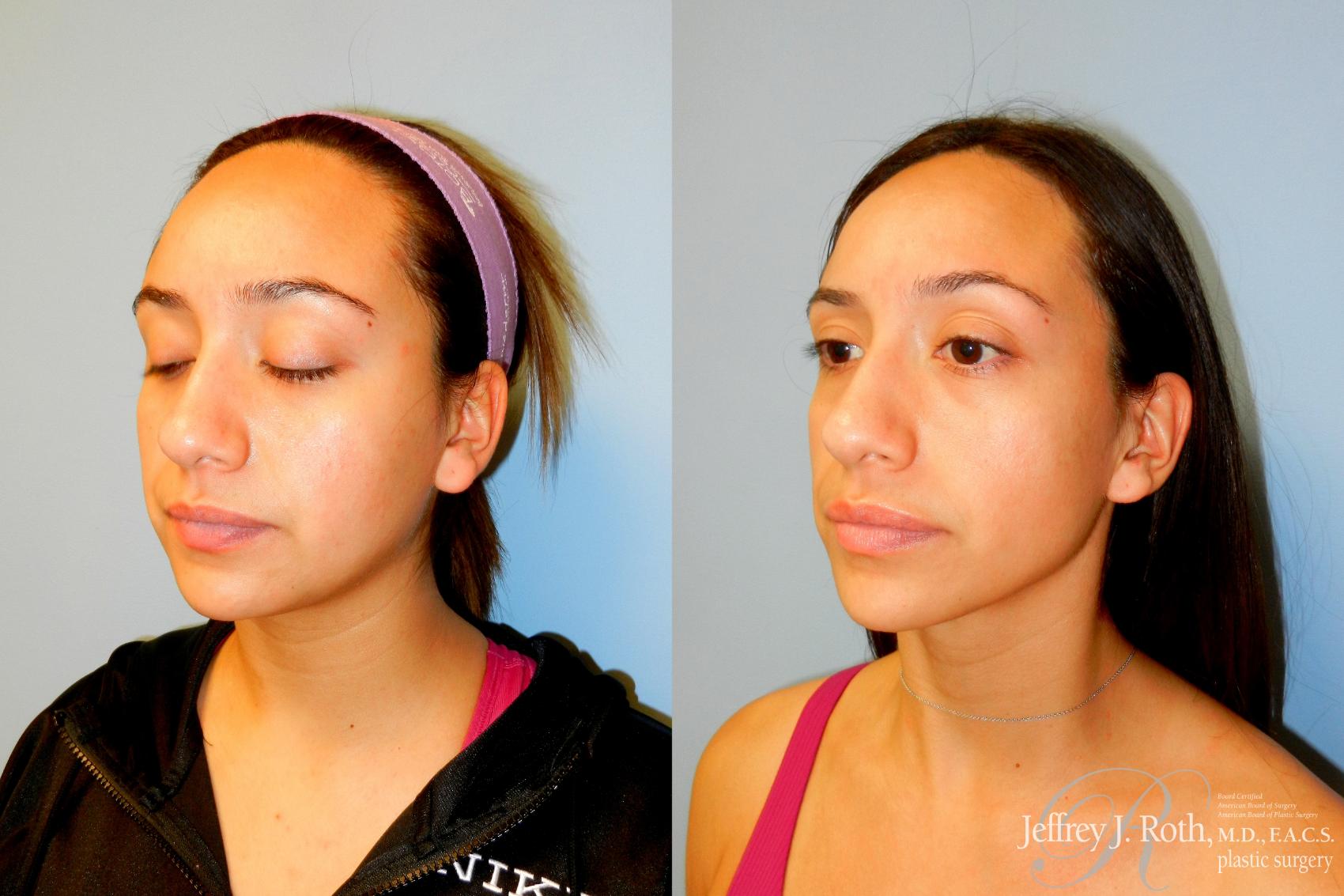 Before & After Earlobe Repair Surgery Case 256 Left Oblique View in Las Vegas and Henderson, NV