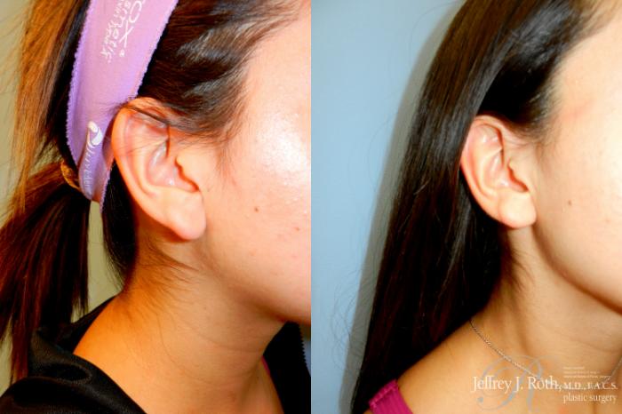 Before & After Earlobe Repair Surgery Case 256 Right Oblique View in Las Vegas and Henderson, NV