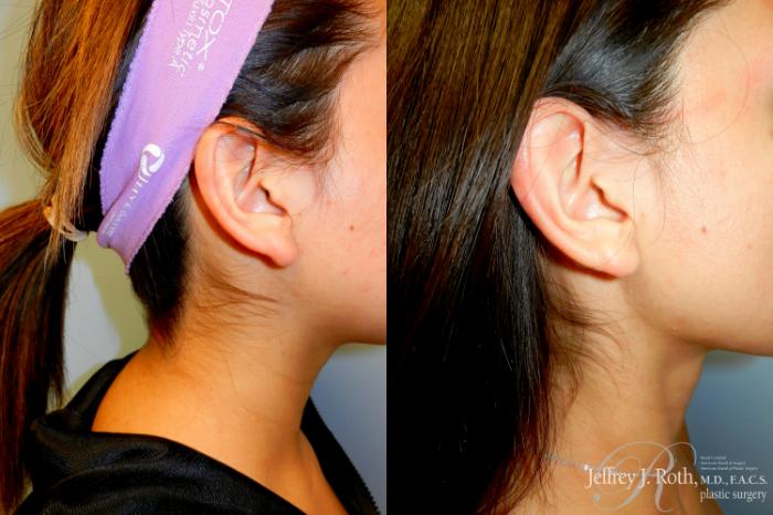 Before & After Earlobe Repair Surgery Case 256 Right Side View in Las Vegas and Henderson, NV