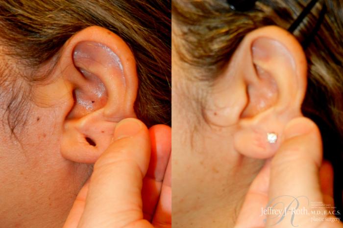 Before & After Earlobe Repair Surgery Case 260 Left Side 2 View in Las Vegas and Henderson, NV