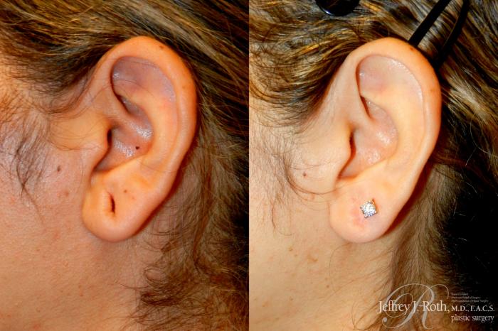 Before & After Earlobe Repair Surgery Case 260 Left Side View in Las Vegas, NV