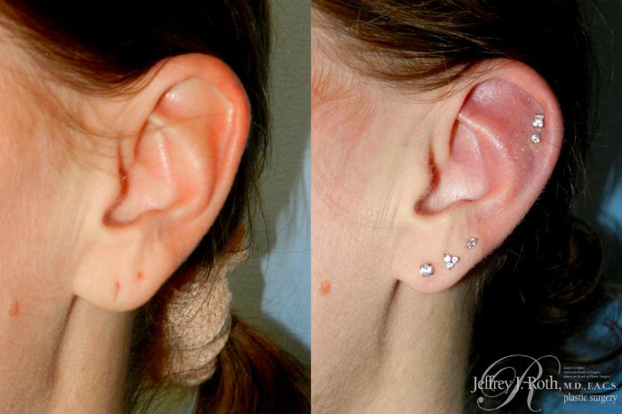 Before & After Earlobe Repair Surgery Case 275 Left Oblique View in Las Vegas and Henderson, NV