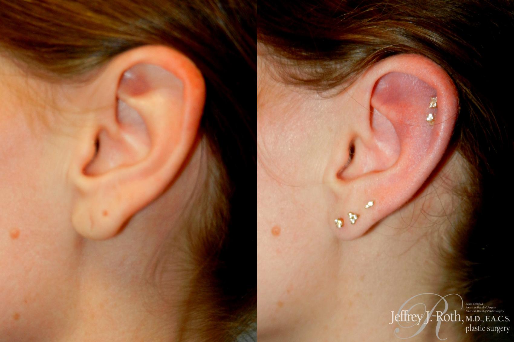 Before & After Earlobe Repair Surgery Case 275 Left Side View in Las Vegas and Henderson, NV