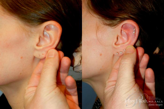 Before & After Earlobe Repair Surgery Case 275 LEFT w/ PULL View in Las Vegas and Henderson, NV