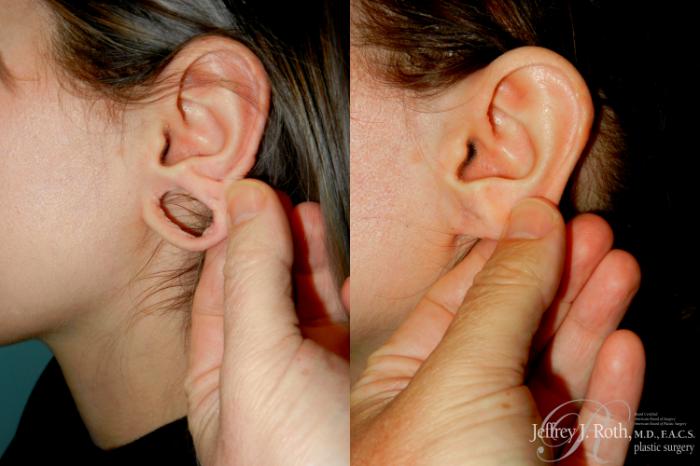 Before & After Earlobe Repair Surgery Case 284 Left Side View in Las Vegas and Henderson, NV