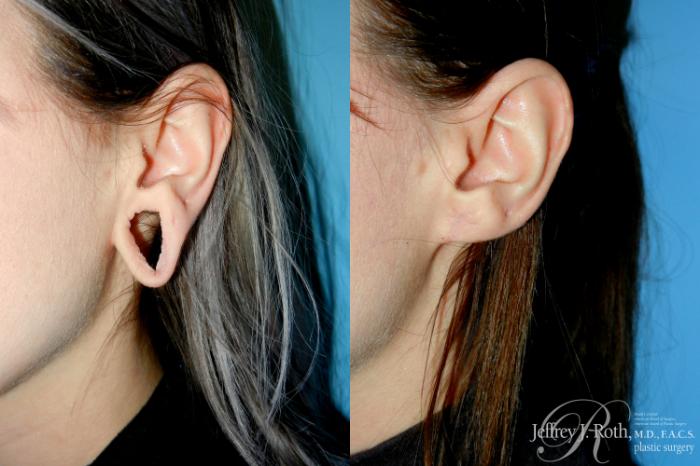 Before & After Earlobe Repair Surgery Case 284 Left Side w/o Pull View in Las Vegas and Henderson, NV