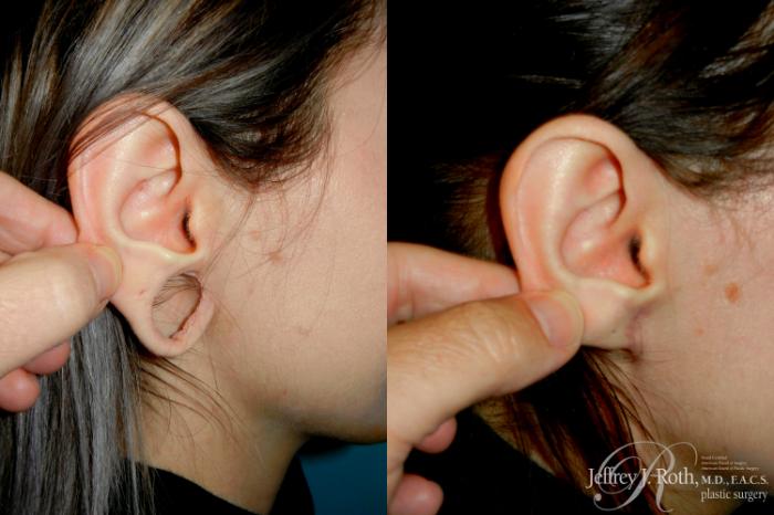 Before & After Earlobe Repair Surgery Case 284 Right Side View in Las Vegas and Henderson, NV