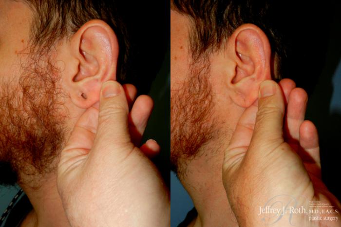 Before & After Earlobe Repair Surgery Case 285 Left Side View in Las Vegas and Henderson, NV