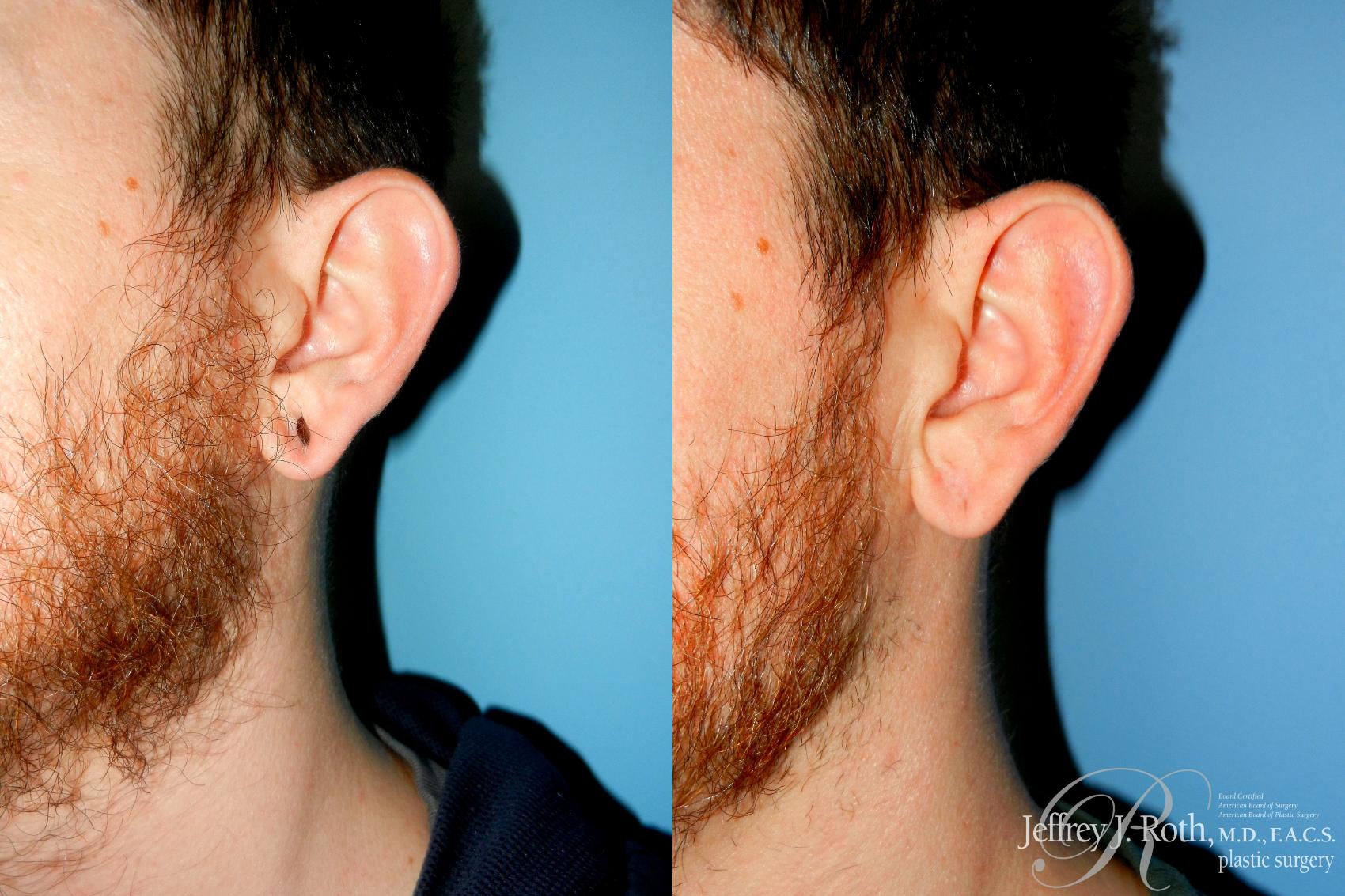 Before & After Earlobe Repair Surgery Case 285 Left Side w/o Pull View in Las Vegas and Henderson, NV
