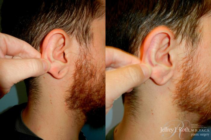 Before & After Earlobe Repair Surgery Case 285 Right Side View in Las Vegas and Henderson, NV