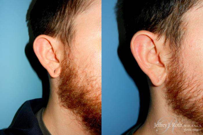 Before & After Earlobe Repair Surgery Case 285 Right Side w/o Pull View in Las Vegas and Henderson, NV