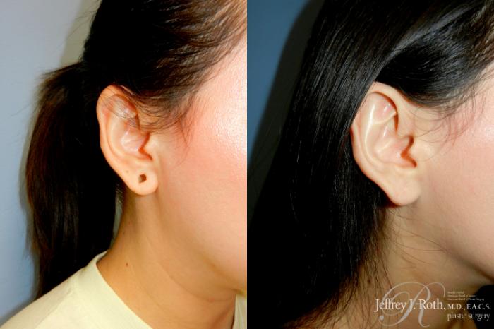 Before & After Earlobe Repair Surgery Case 287 Right Oblique View in Las Vegas and Henderson, NV