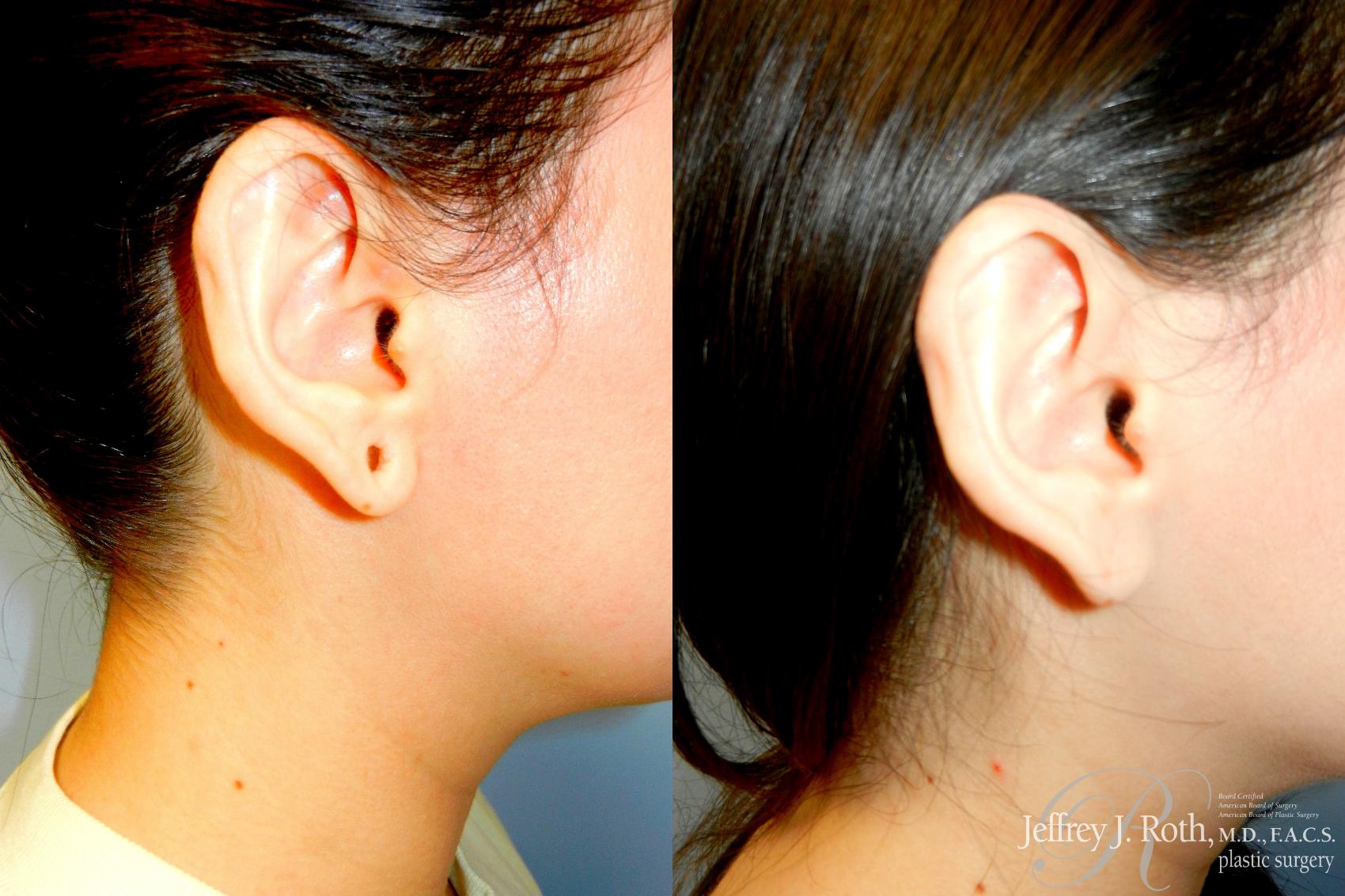 Before & After Earlobe Repair Surgery Case 287 Right Side View in Las Vegas and Henderson, NV
